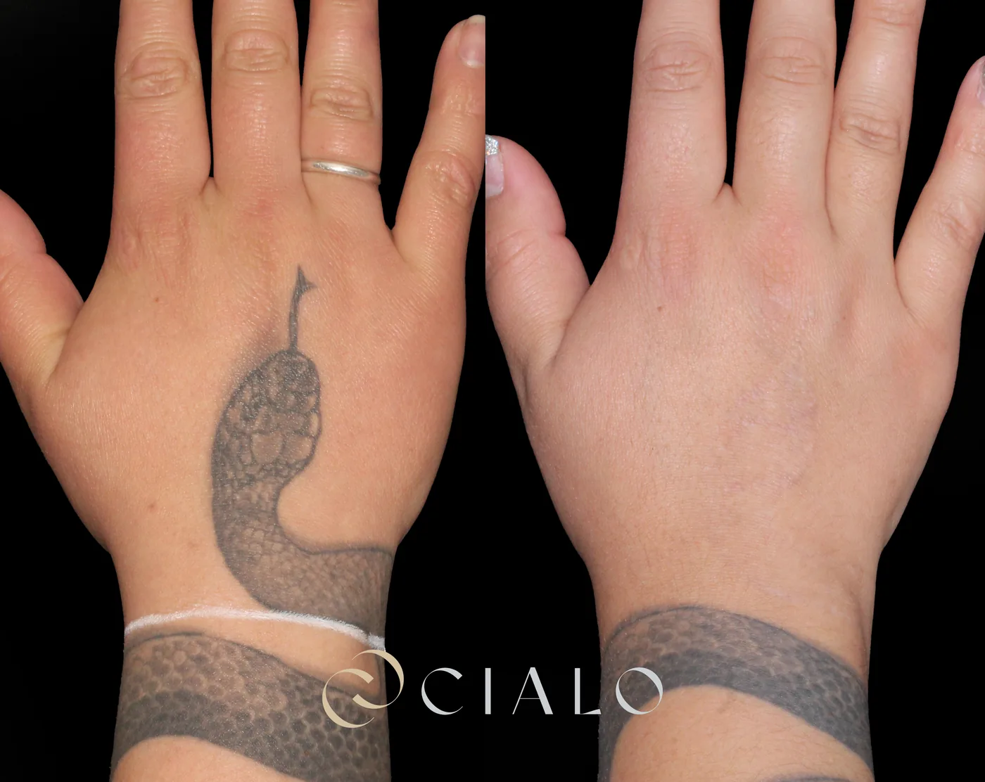 Borrado de Tatuajes en Clínica Cialo — imagen 3