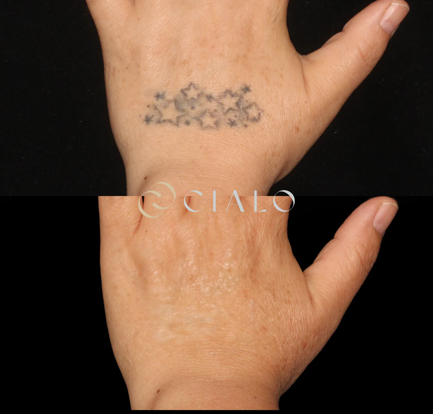 Borrado de Tatuajes en Clínica Cialo — imagen 4