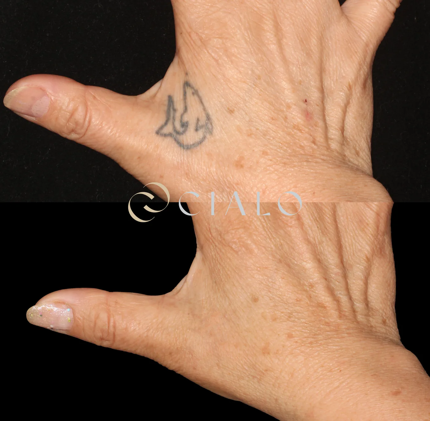 Borrado de Tatuajes en Clínica Cialo — imagen 5