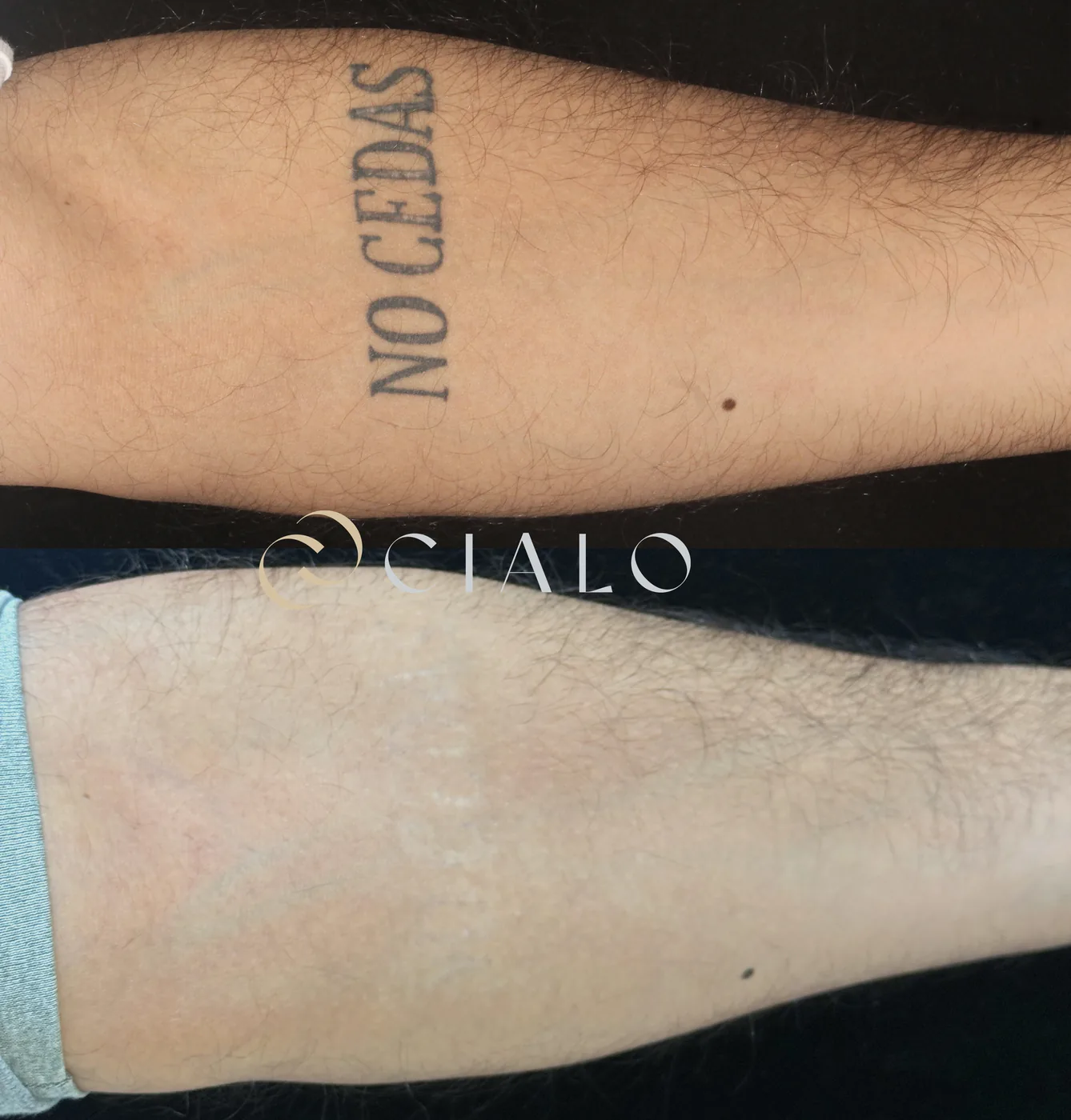Borrado de Tatuajes en Clínica Cialo — imagen 6