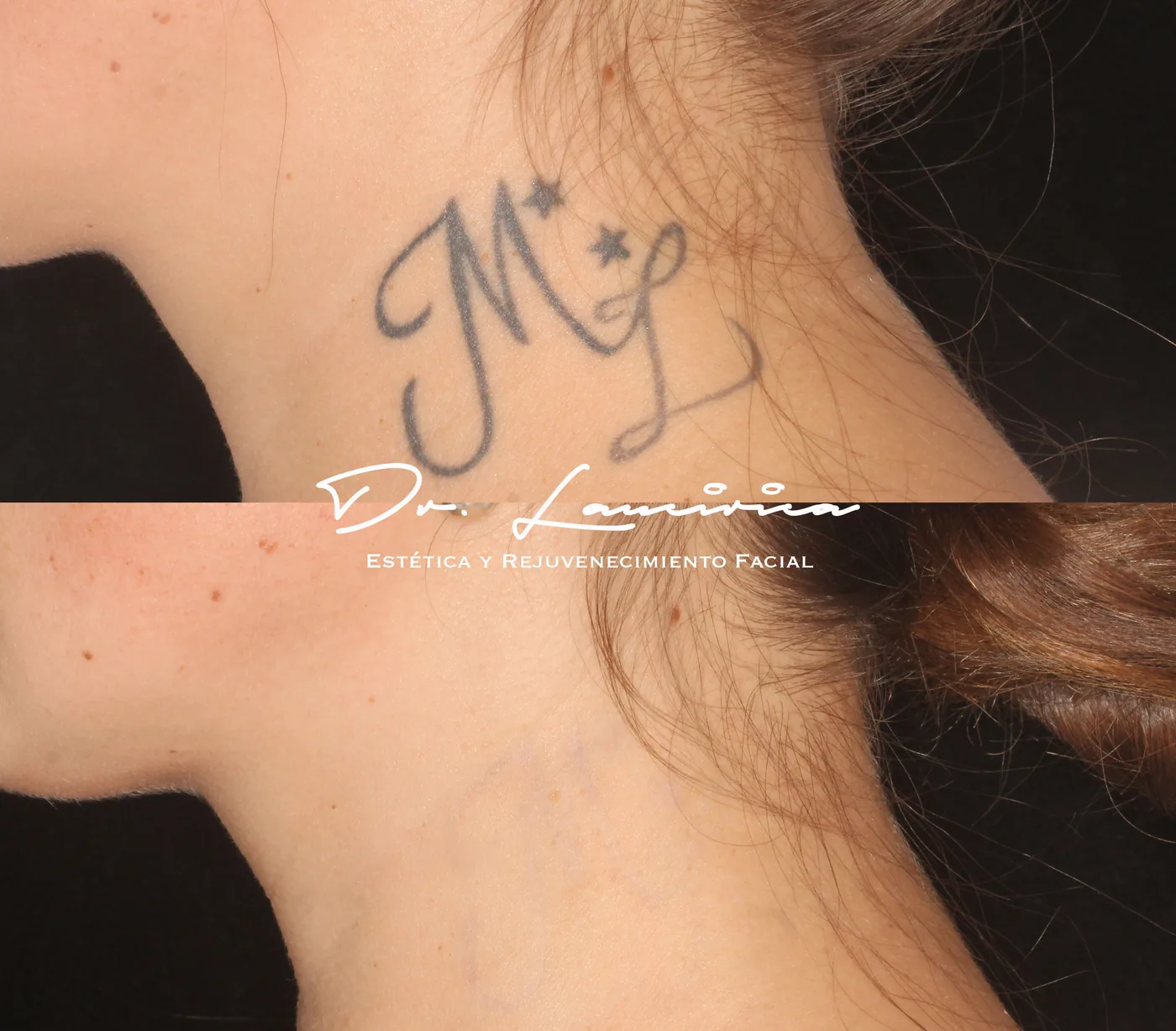 Borrado de Tatuajes en Clínica Cialo — imagen 7