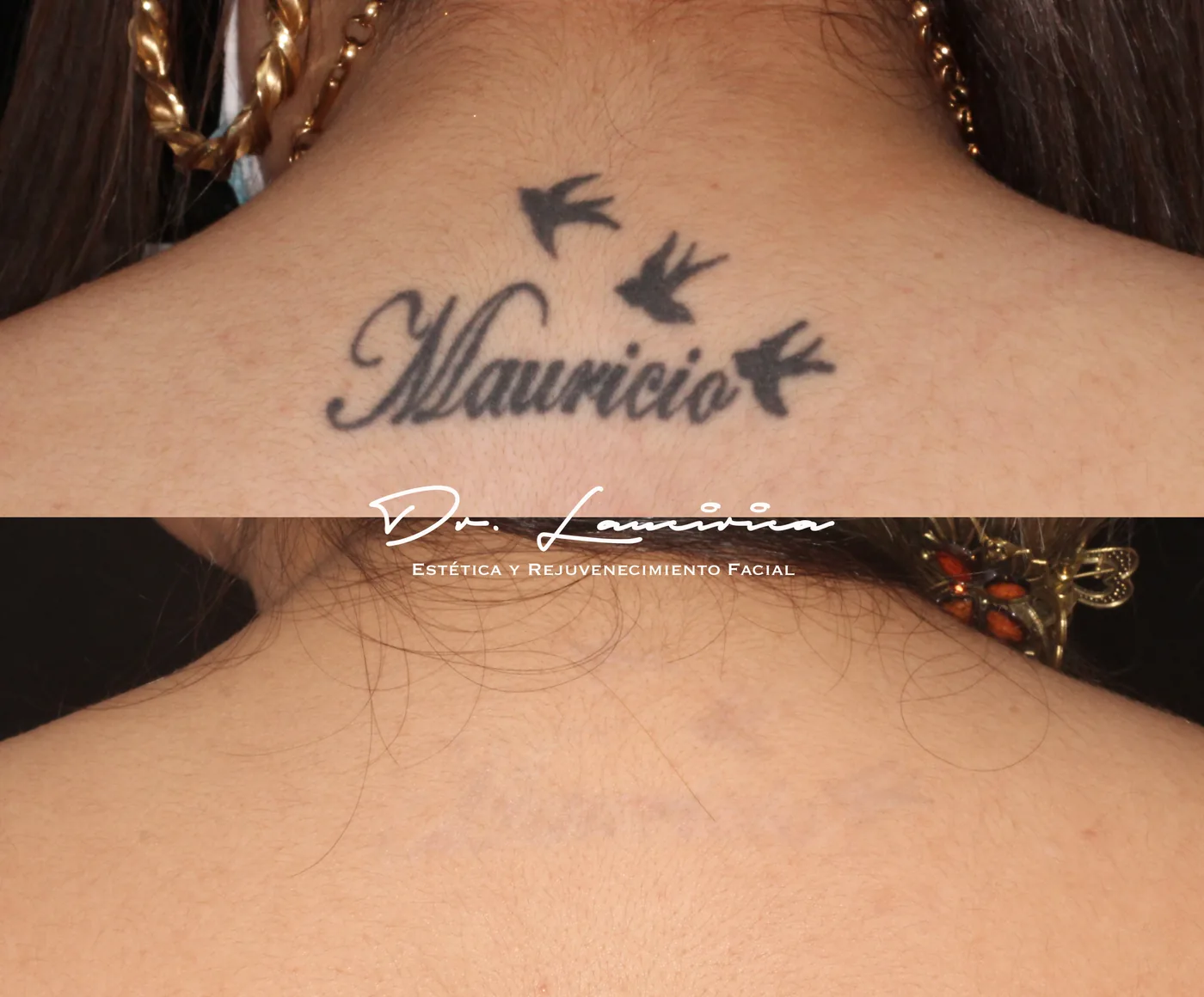 Borrado de Tatuajes en Clínica Cialo — imagen 8