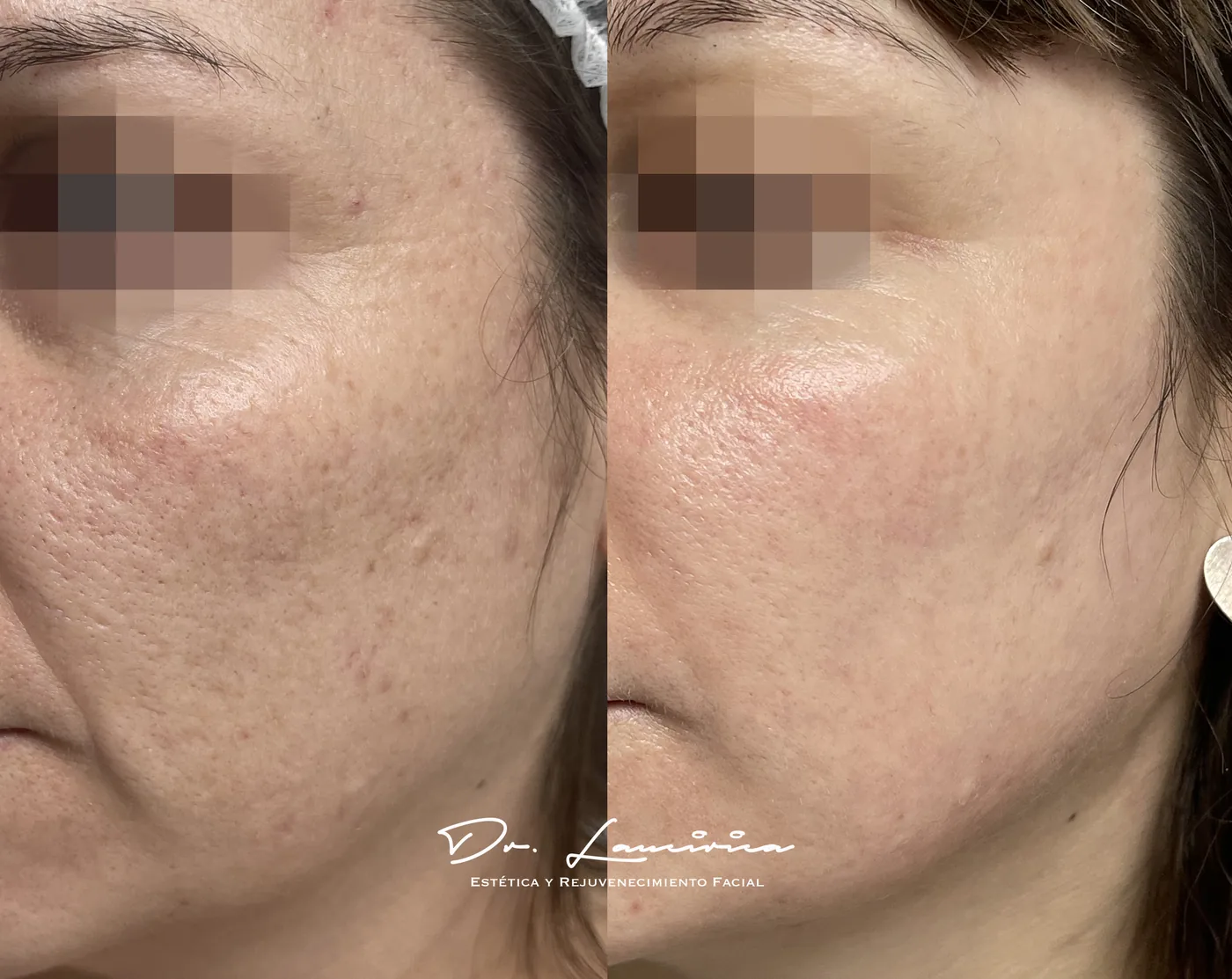 Tratamiento para Cicatrices de Acné — tratamiento de facial en Clínica Cialo, Los Ángeles