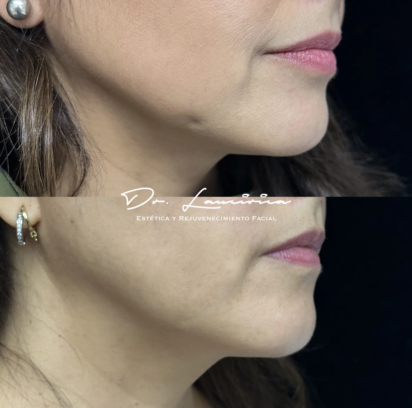 Cool Peel (Láser CO₂) en Clínica Cialo — imagen 5