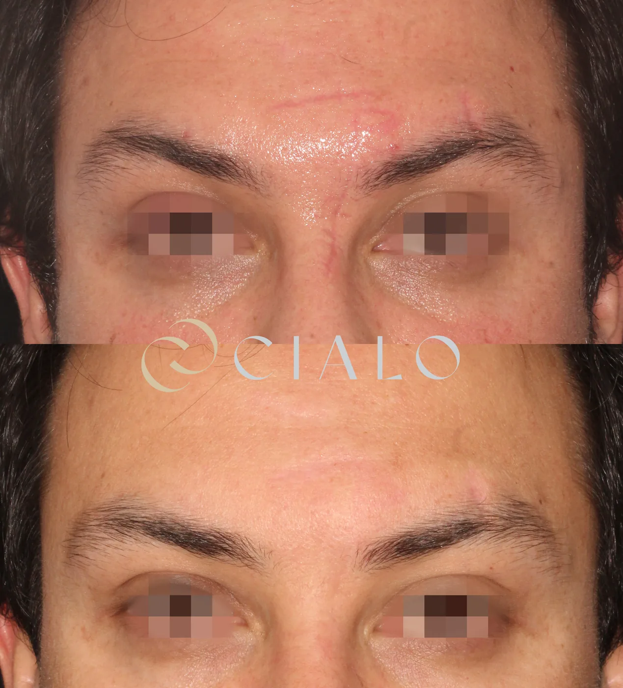 Cool Peel (Láser CO₂) en Clínica Cialo — imagen 7