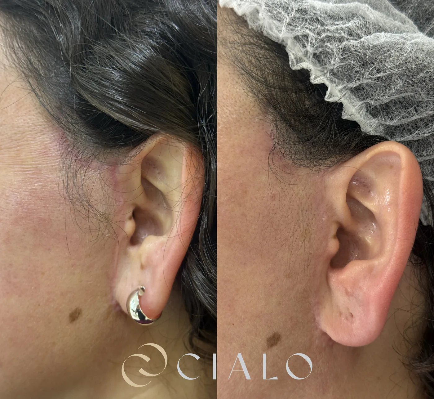 Cool Peel (Láser CO₂) en Clínica Cialo — imagen 8