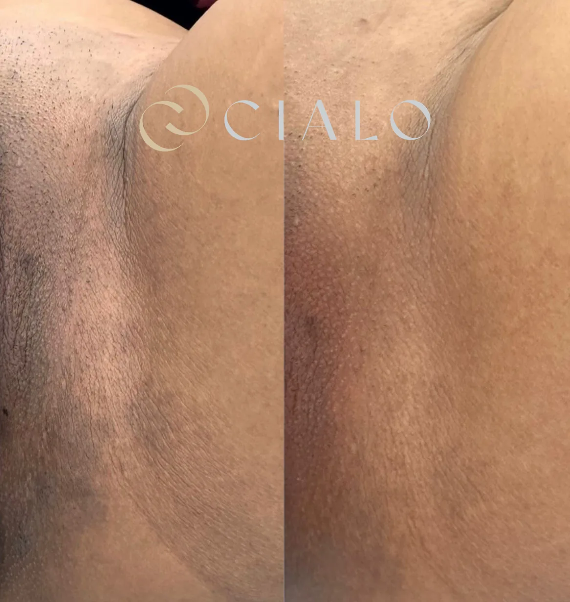 Tratamiento para Melasma en Clínica Cialo — imagen 8