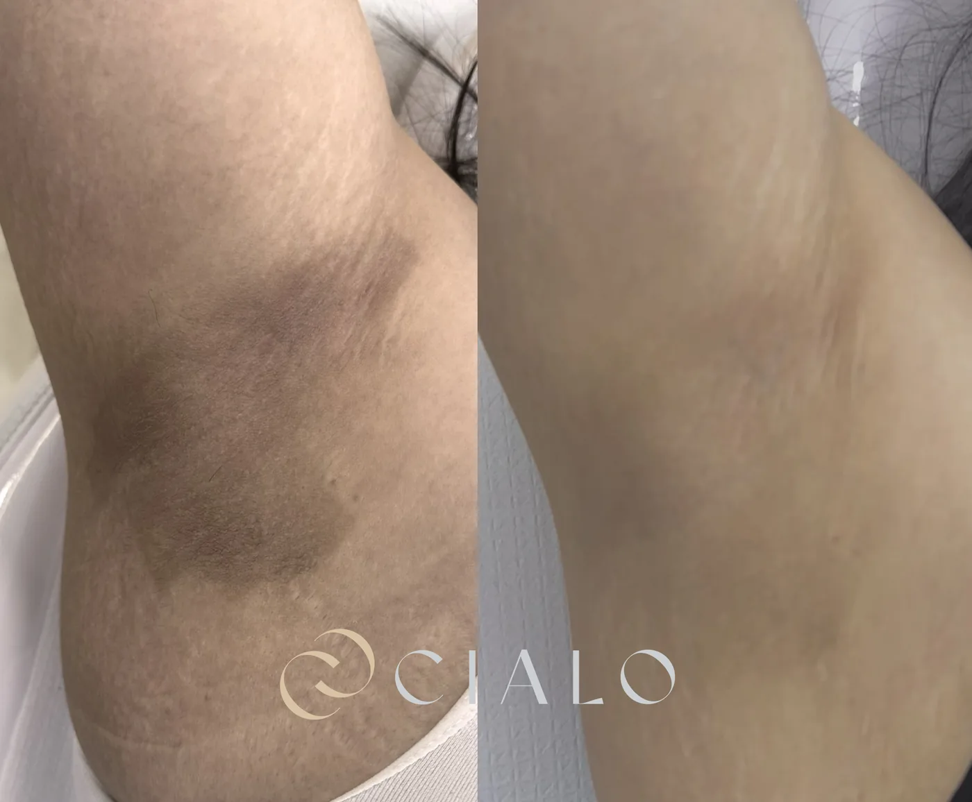 Tratamiento para Melasma en Clínica Cialo — imagen 9