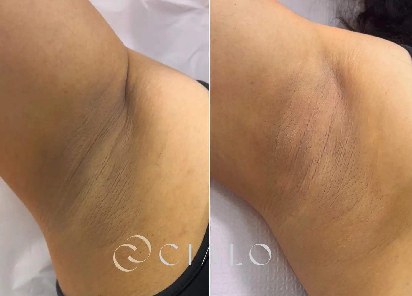 Tratamiento para Melasma en Clínica Cialo — imagen 10