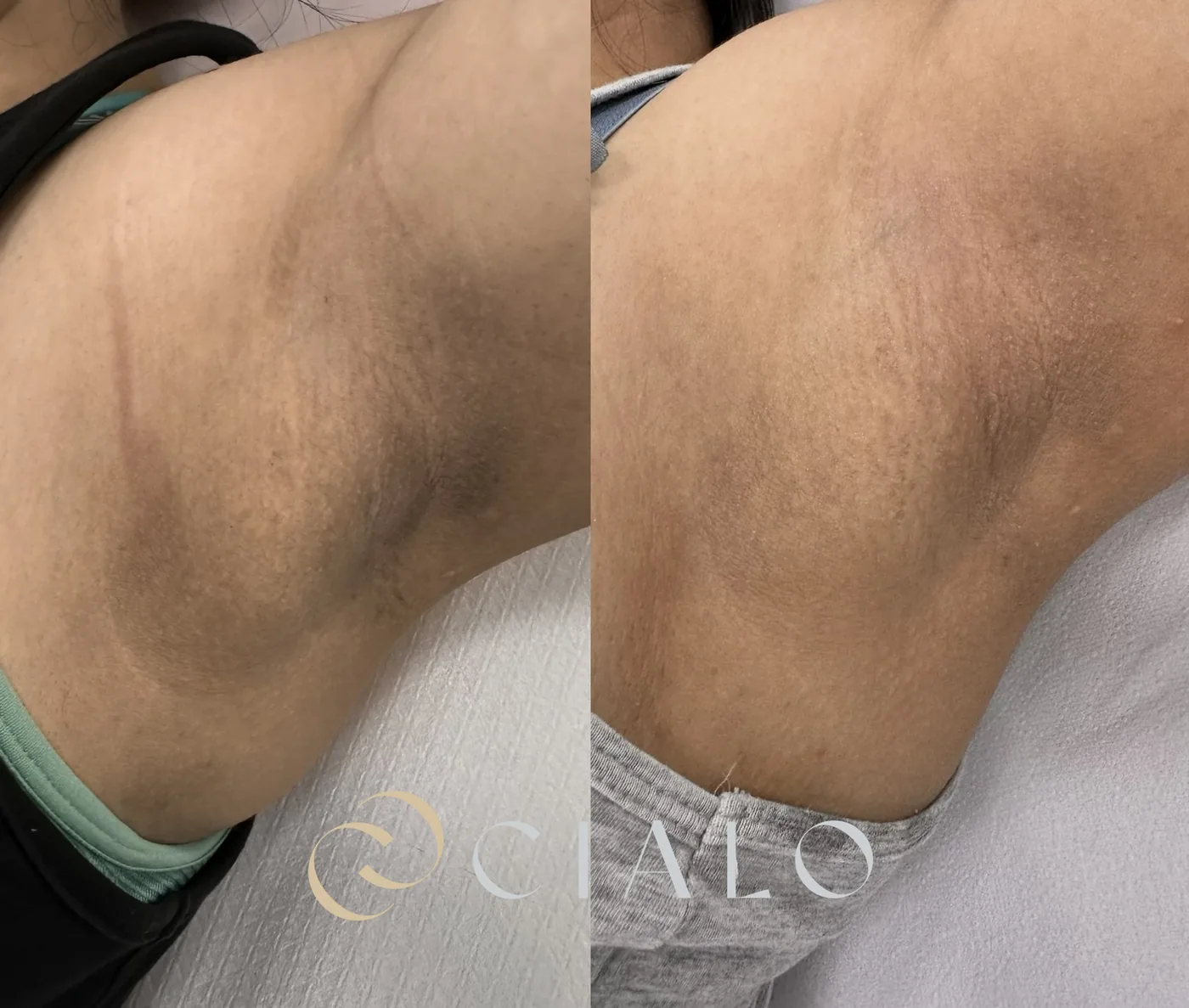 Tratamiento para Melasma en Clínica Cialo — imagen 11