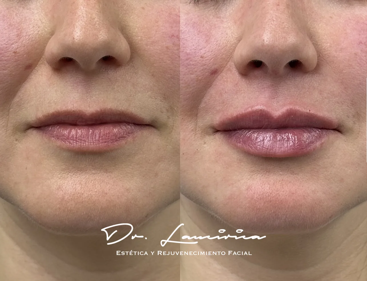 Antes y después · Aumento de labios en Clínica CIALO