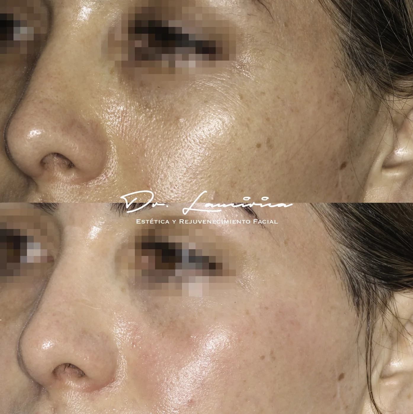 Cool Peel (Láser CO₂) — tratamiento de facial en Clínica Cialo, Los Ángeles