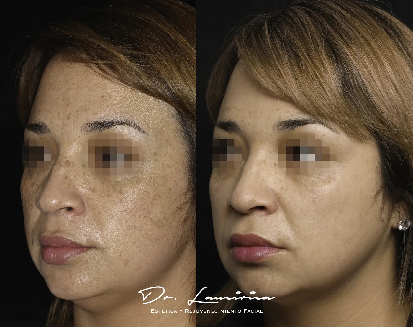 Cool Peel (Láser CO₂) en Clínica Cialo — imagen 2