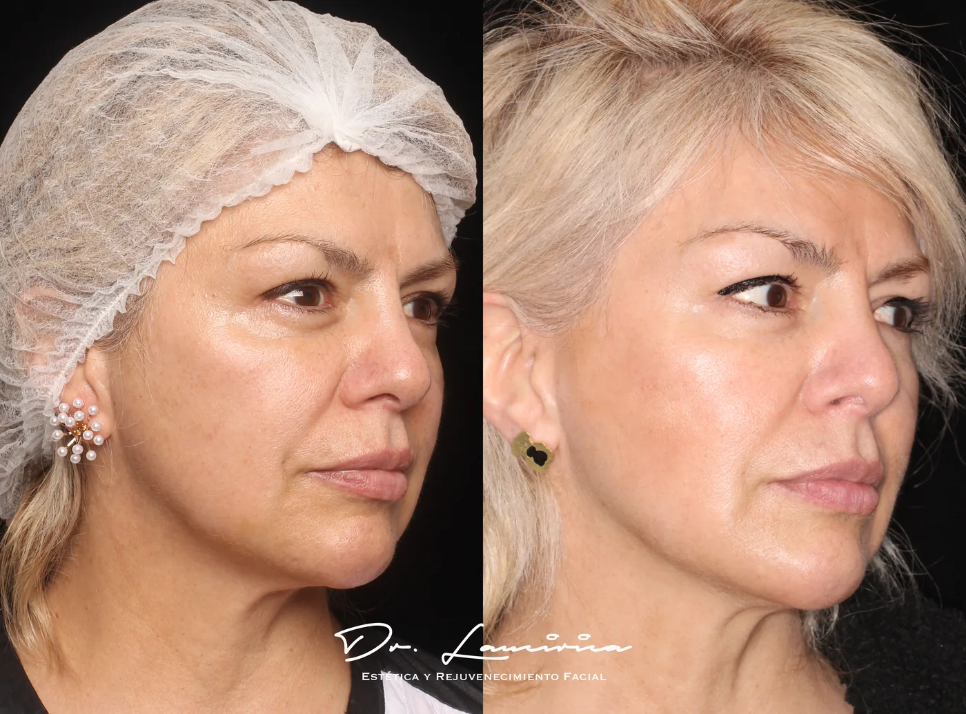 Cool Peel (Láser CO₂) en Clínica Cialo — imagen 4
