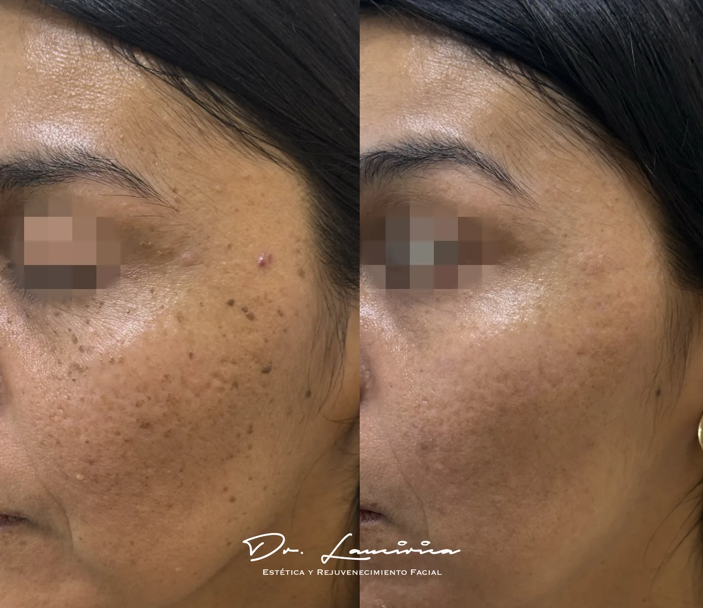 Tratamiento para Melasma en Clínica Cialo — imagen 4