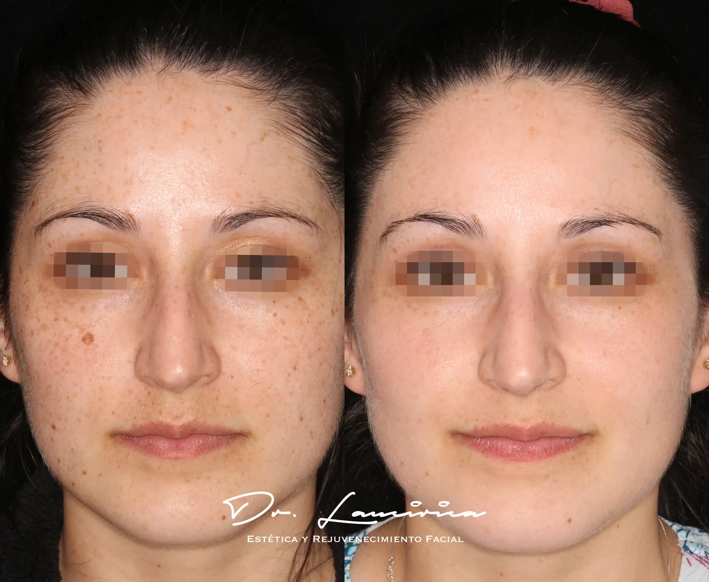 Tratamiento para Melasma en Clínica Cialo — imagen 5