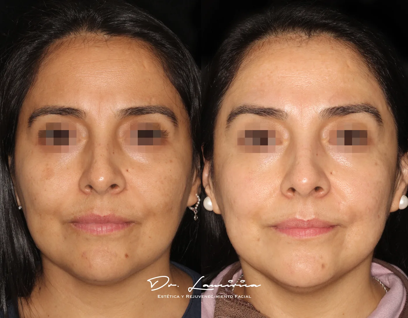 Tratamiento para Melasma en Clínica Cialo — imagen 7