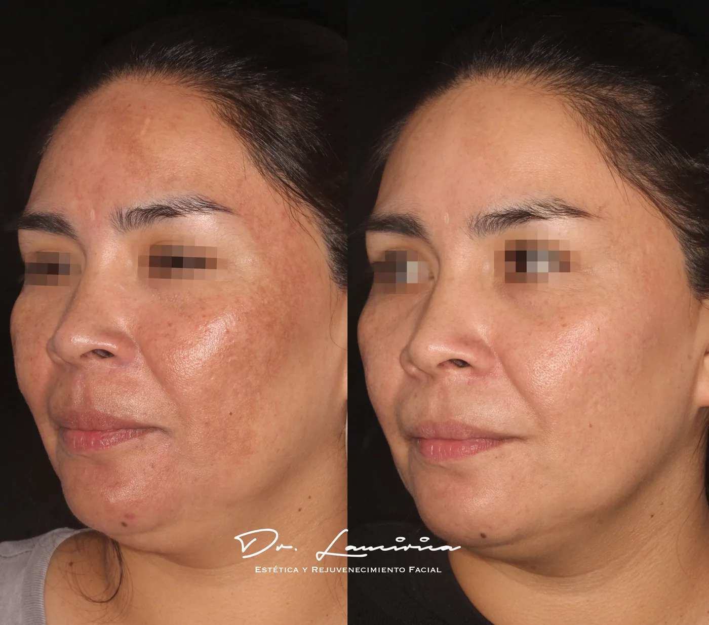 Tratamiento para Melasma en Clínica Cialo — imagen 2