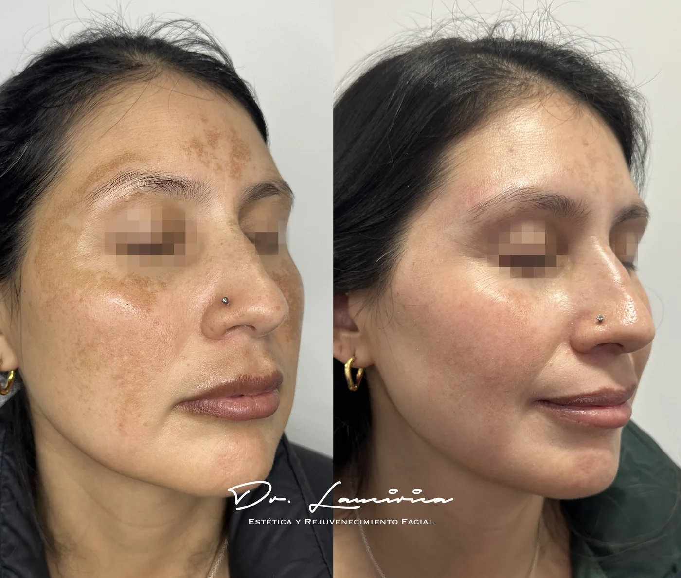 Tratamiento para Melasma en Clínica Cialo — imagen 3