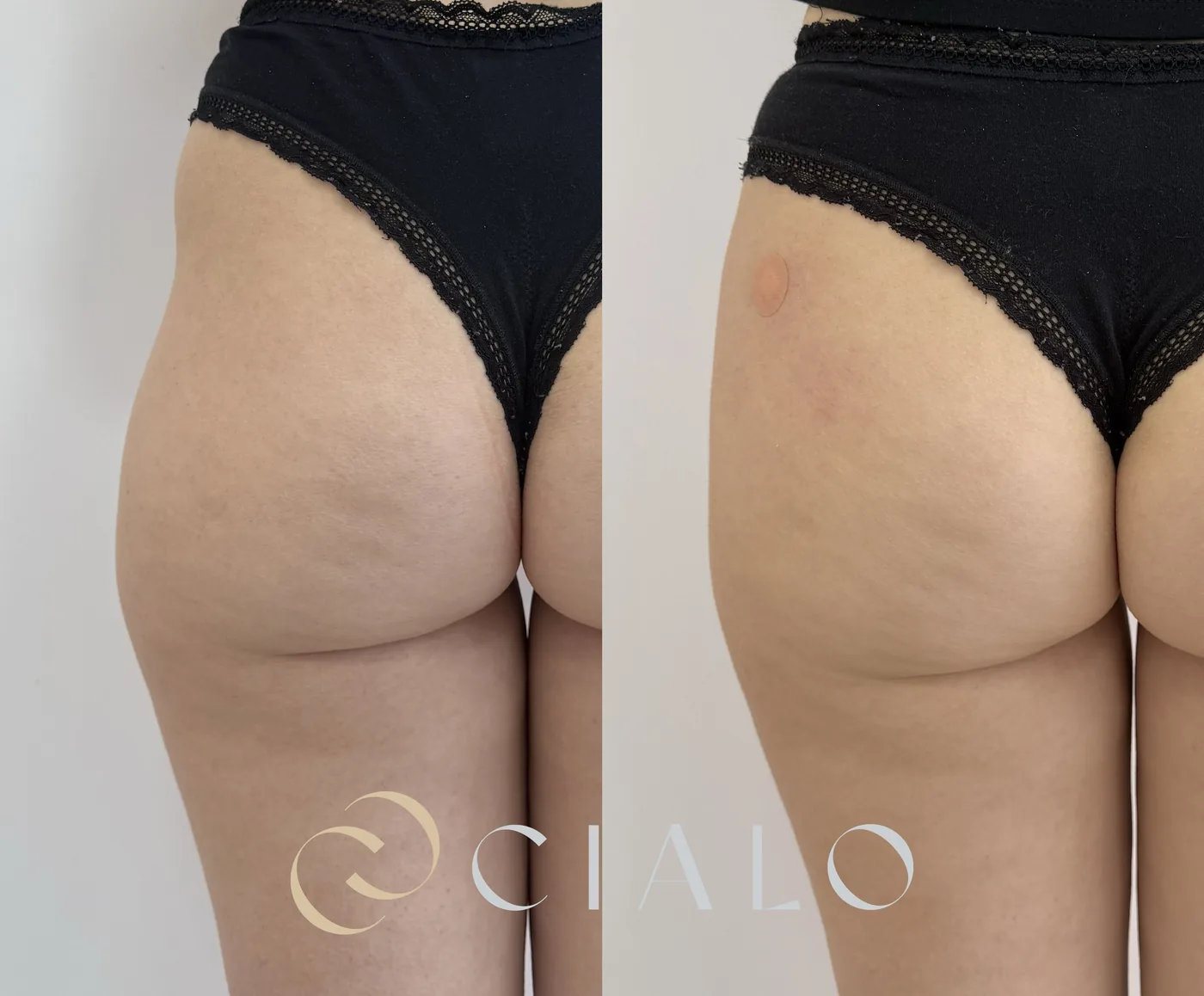 Relleno con Ácido Hialurónico en Clínica Cialo — imagen 10