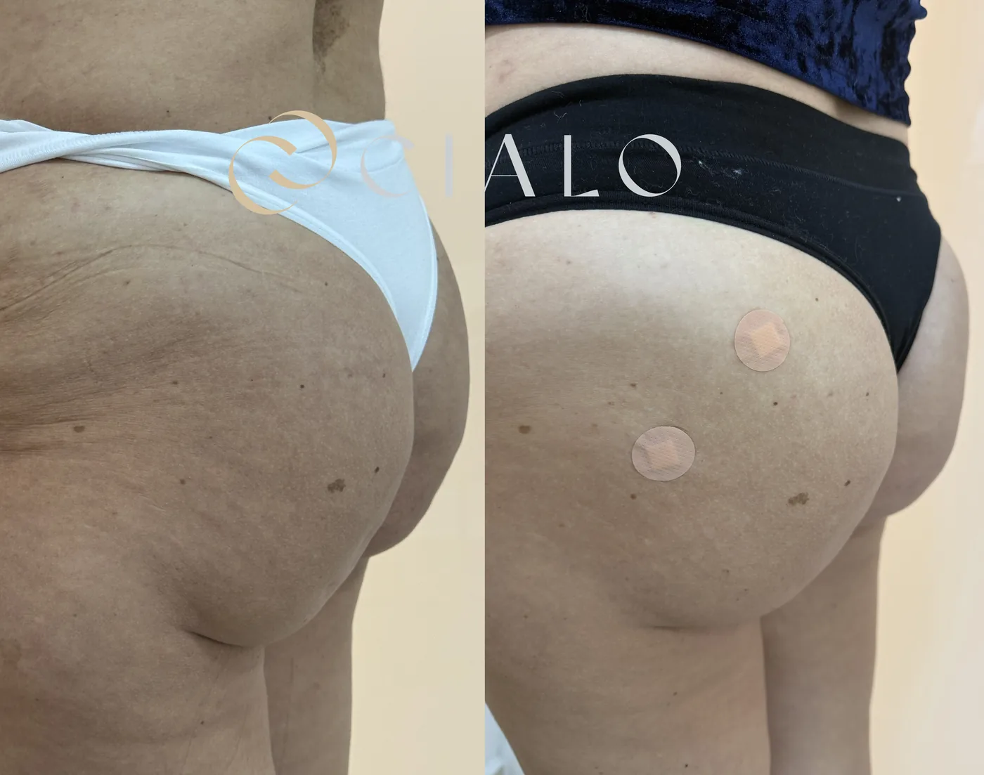 Relleno con Ácido Hialurónico en Clínica Cialo — imagen 11