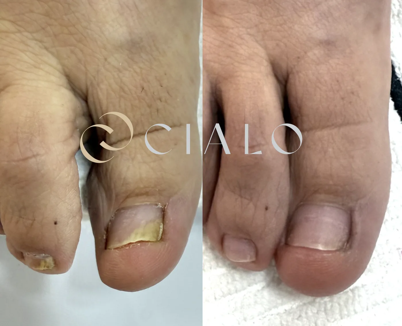 Onicomicosis (Hongos en Uñas) con Láser CO2 — tratamiento de corporal en Clínica Cialo, Los Ángeles