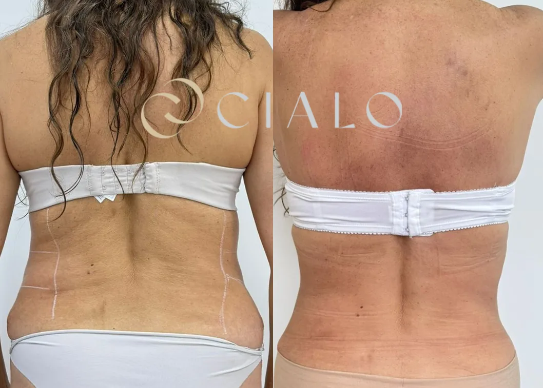 Antes y después · Reductivo corporal en Clínica CIALO