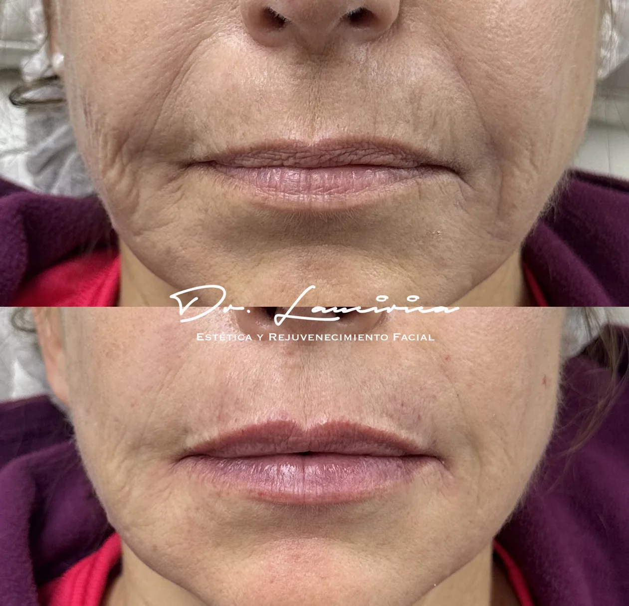 Relleno de Labios — tratamiento de facial en Clínica Cialo, Los Ángeles