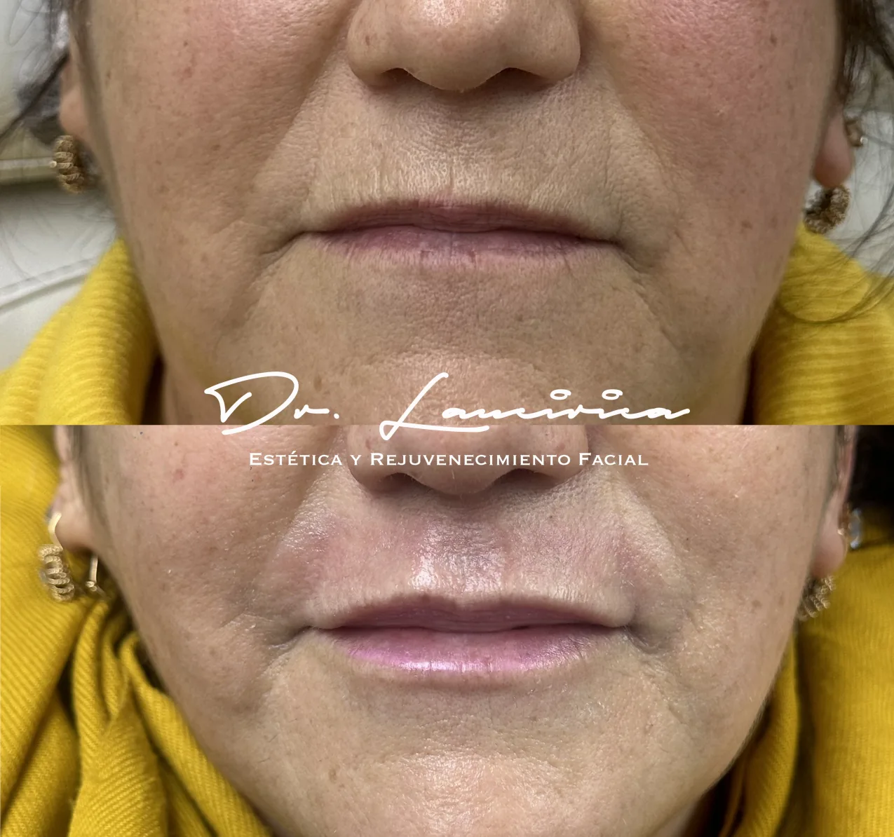 Relleno de Labios en Clínica Cialo — imagen 2