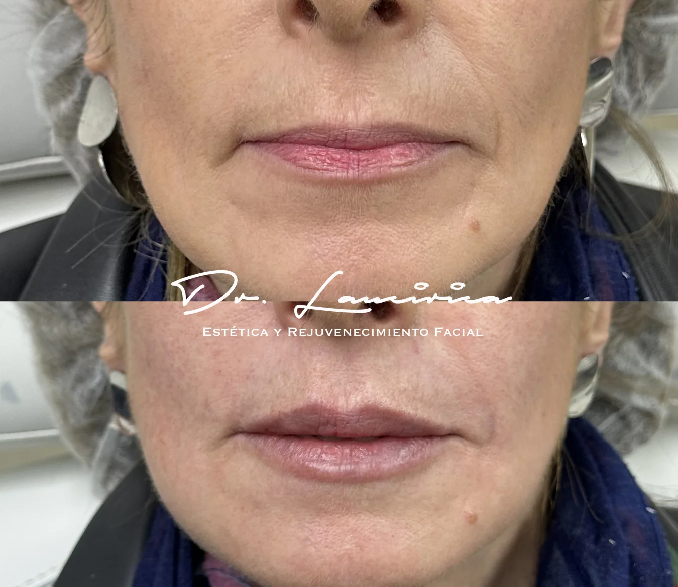 Relleno de Labios en Clínica Cialo — imagen 3