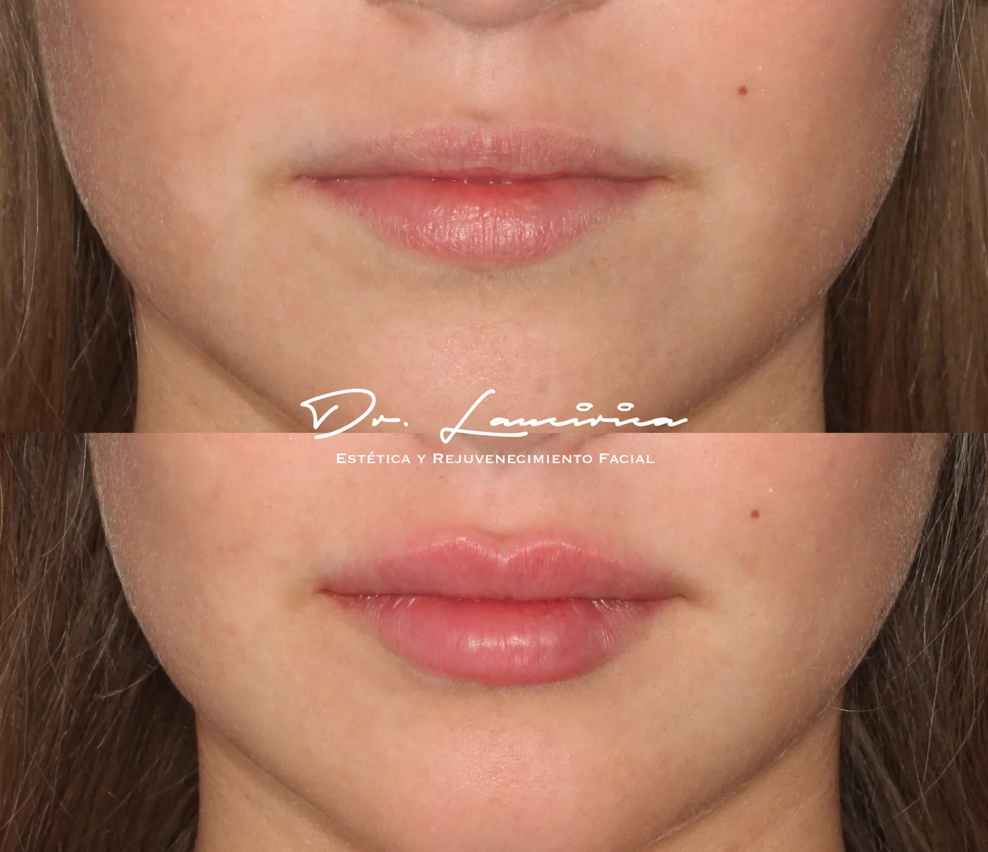 Relleno de Labios en Clínica Cialo — imagen 5