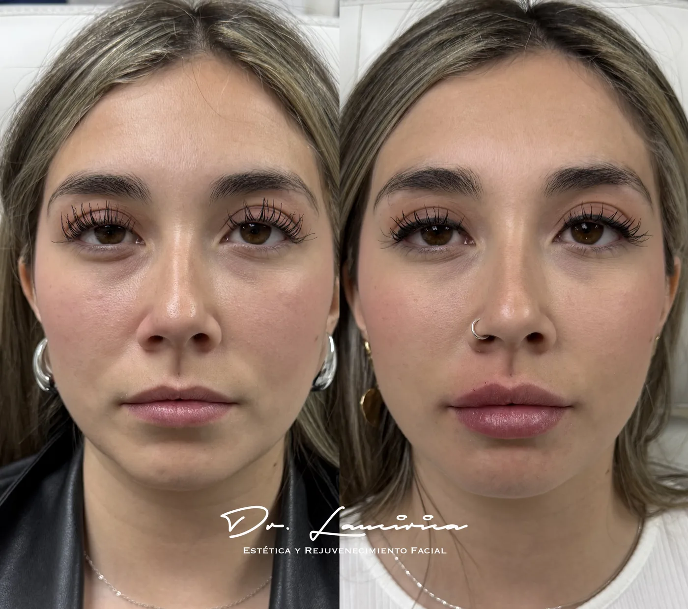 Relleno de Labios en Clínica Cialo — imagen 6