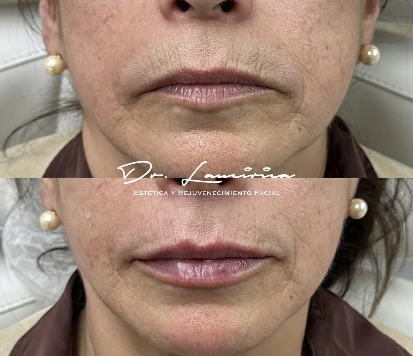 Relleno de Labios en Clínica Cialo — imagen 7