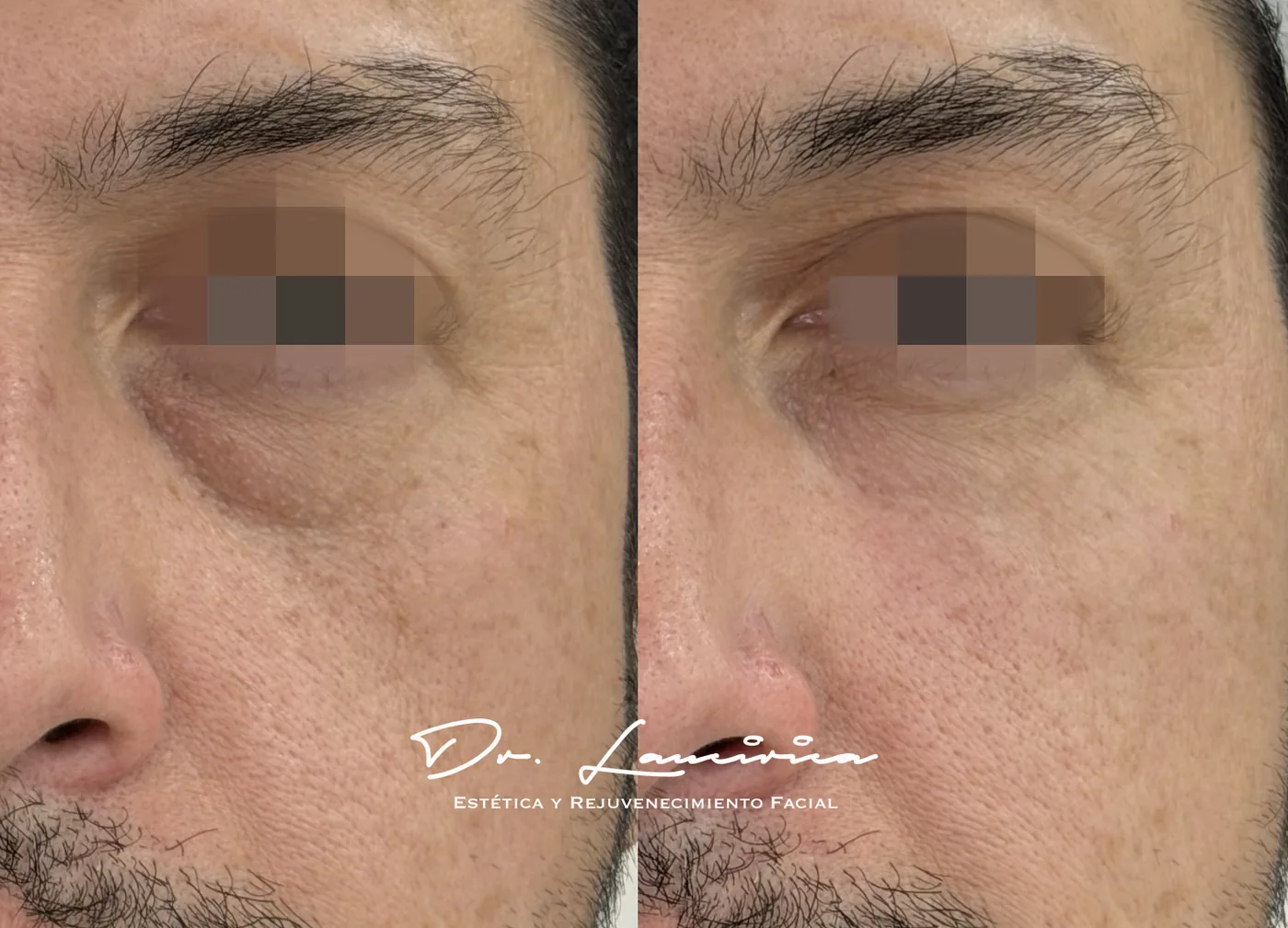 Relleno con Ácido Hialurónico — tratamiento de facial en Clínica Cialo, Los Ángeles