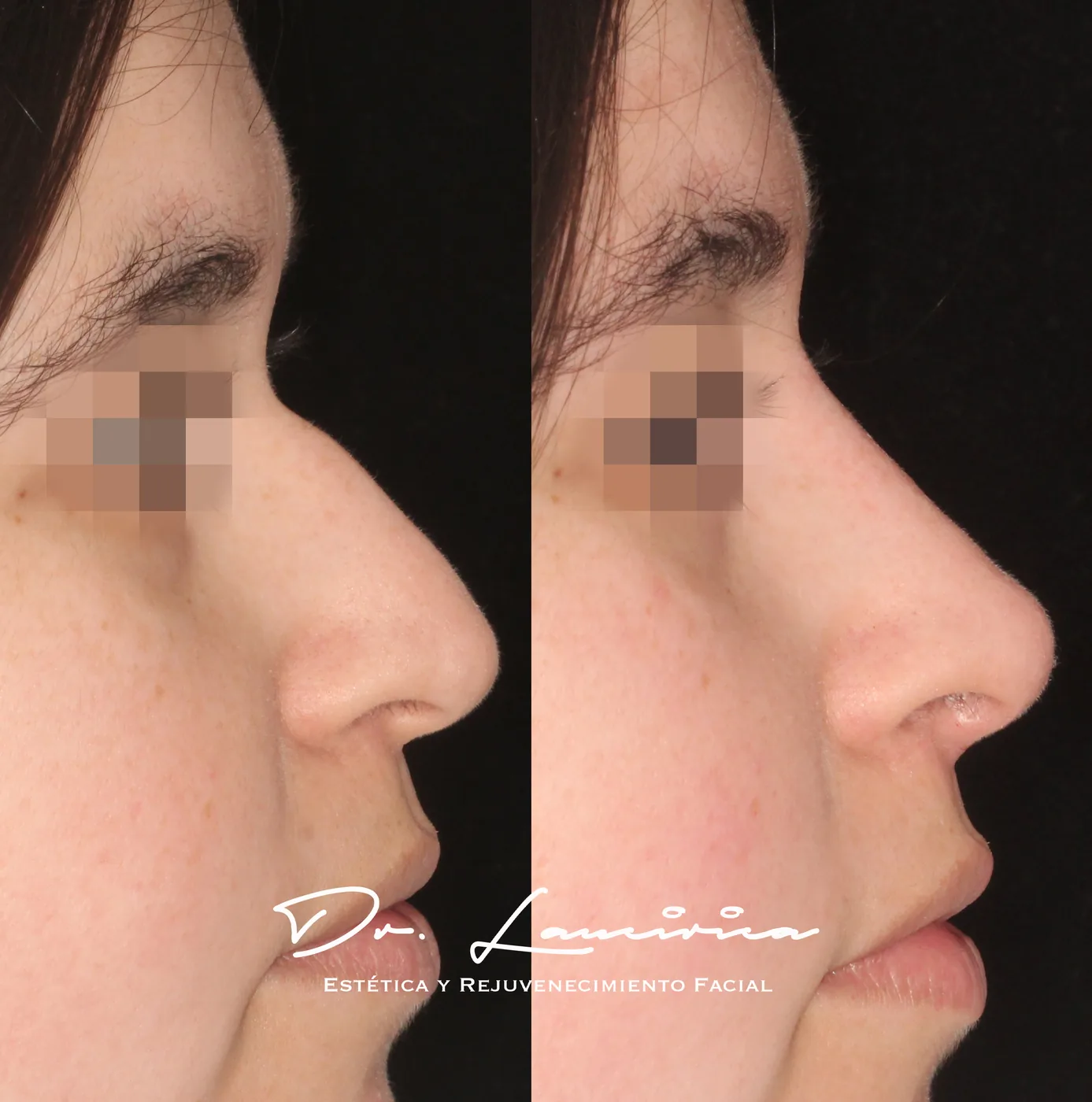 Rinomodelación — tratamiento de facial en Clínica Cialo, Los Ángeles