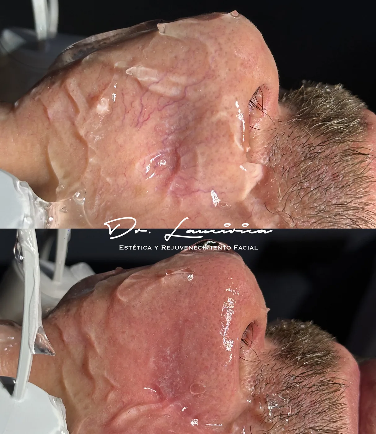 Tratamiento para Rosácea en Clínica Cialo — imagen 1