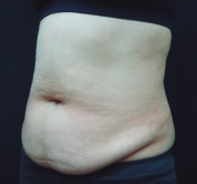 Antes del tratamiento de criolipólisis en abdomen
