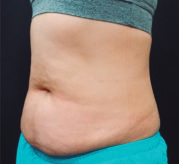 Después del tratamiento de criolipólisis en abdomen